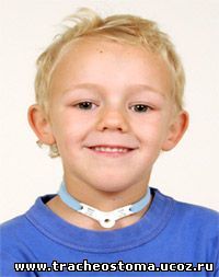 Уход за ребенком с трахеостомой